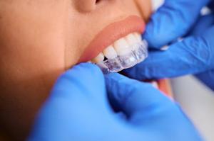 FirstClass Aligners Gives Patients Access to Professional Clear Aligner Tune-Ups