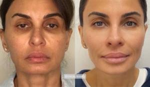 Dr. Simon Ourian Reviews Facelift Surgery: The Pros and Cons of Surgical vs. Non-Surgical Facelifts