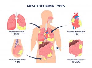 Types of Mesothelioma