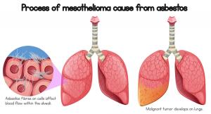 Progression of Mesothelioma