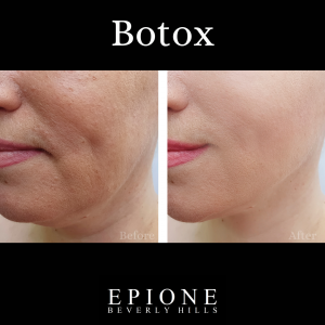 Dr. Simon Ourian Reviews Botox Injections: Smoothing Out Wrinkles