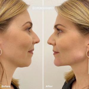 Side-by-side before and after images of a woman’s profile highlighting the results of jawline contouring. The after photo shows a significantly more defined jawline and a sleeker, more contoured neck area, demonstrating the effectiveness of the treatment 