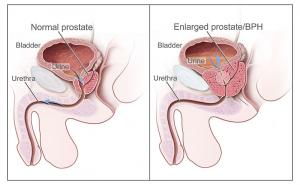 Benign Prostatic Hyperplasia Treatment market1