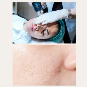 A close-up image of a person receiving a microneedling treatment on the face, followed by a detailed view of the skin showing minimized pores and improved texture after the procedure.