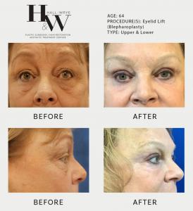 Hall & Wrye Plastic Surgeons Highlight the Importance of Timing for Eyelid Surgery