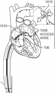 Retriever Medical Announces Notice of Allowance for Innovative Occlusion Device