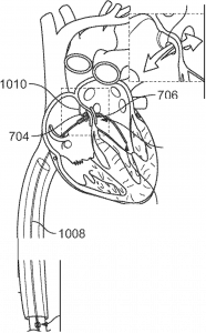 Image showing the proximal sphere positioned to cover the right atrial side of an atrial septal defect (ASD). Both spheres are in place to effectively close the defect.