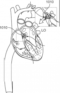 Final view of deployed discs in place, successfully closing an atrial septal defect.