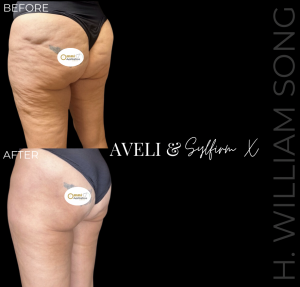 Omni Aesthetics Introduces Groundbreaking Aveli Cellulite Solution for Smoother, Firmer Skin