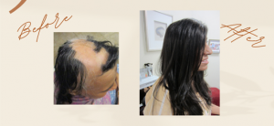 Thursday’s Calabasas Supports Alopecia Awareness Month with Innovative, Non-Surgical, Hair Loss Solutions