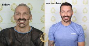 hair transplant before and after