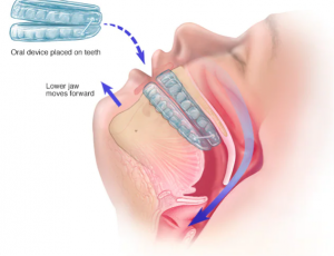 FDA Cleared & PDAC Approved Mandibular Advancement, CPAP Alternatives, Dental sleep medicine