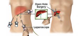 Laparoscopic and Open Hernia Mesh Repair Surgery Market Report, Size, Share Report 2024-2032