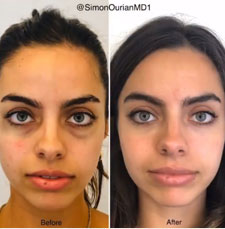 Side-by-side comparison of a woman's face before and after dark circle removal treatment. The 'before' image shows prominent under-eye circles, while the 'after' image reveals a refreshed, brighter appearance