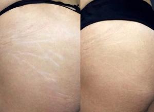 Side-by-side comparison of stretch mark reduction, showing a noticeable improvement in skin texture and smoothness after treatment at Epione Beverly Hills.