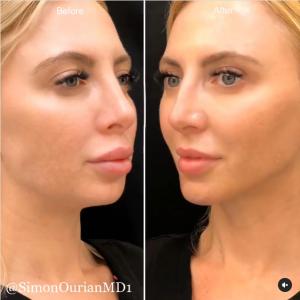 Before and after photo of a woman showing results from Dr. Simon Ourian’s non-surgical chin contouring treatment, highlighting improved jawline definition and balanced facial contours