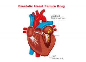 Diastolic Heart Failure Drug Market 2024-2032