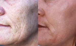 Side-by-side comparison showing significant wrinkle reduction on a patient's face after undergoing Dr. Simon Ourian's non-surgical wrinkle removal treatment. The left side displays the skin with deep wrinkles before the procedure, while the right side sho