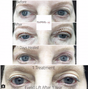 Plamere Plasma Fibroblast Eyelid Lift Treatment by Plasma Pen Pro (PPP)