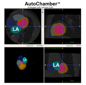 AutoChamber AI segmentation showing left atrial enlargement