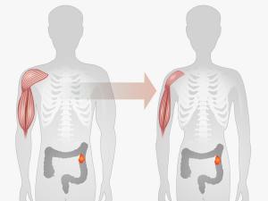 Mercado de caquexia por cáncer 2024-2032