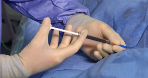 The GPX Embolic Device used in a portal vein embolization procedure