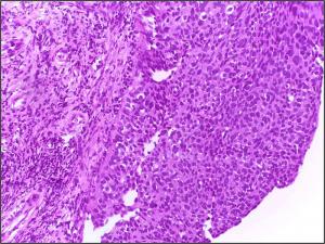 Cervical Intraepithelial Neoplasia Market