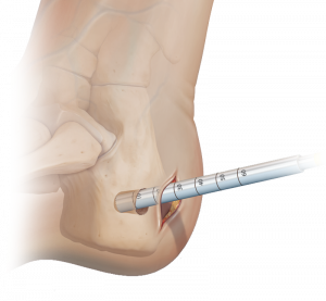 Bone Graft Harvester Market