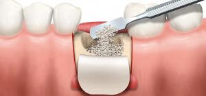 Dental Bone Graft Substitute