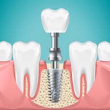 Dental Implants Market Insights