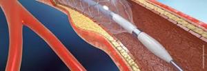 Coronary Stents