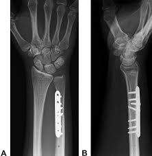 Ulna Osteotomy Plate