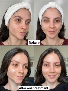 ReGlow Micro Infusion - Before and After 1 Treatment