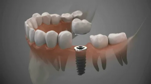 Dental Implants Prosthesis Market