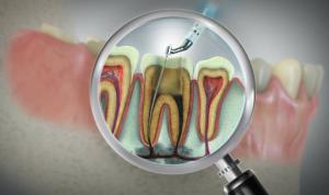 root canal specialist New York