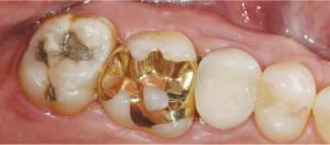 Global Composite Resin market