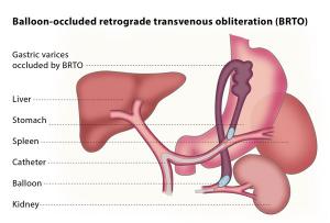 Kidney Balloon industry1