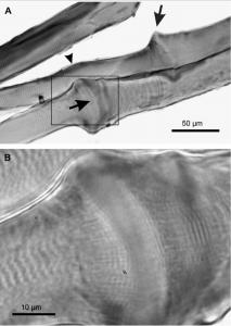 Potential Trigger Point Foci (acute sites of contractility within a muscle) - https://brookbushinstitute.com/glossary/taut-band
