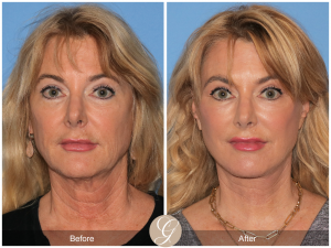 https://drkevinsadati.com/gallery/facelift/deep-plane-facelift/08/