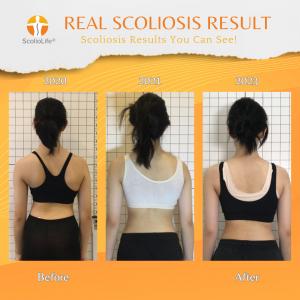 Scoliosis Results You Can See Approach Finally Coming to Malaysia