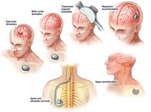 Neurostimulation Devices