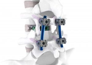 Image of the LineSider Modular Cortical Screws