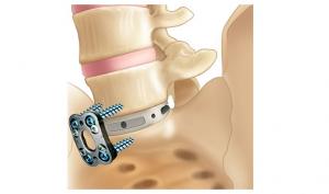 Spinal Fusion Devices Market Growth
