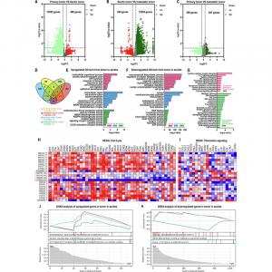 Transcriptomic profiling suggests potential reactivation and stimulation of disseminated ovarian cancer (OC) cell metabolism and proliferation by peritoneal adipose tissue.