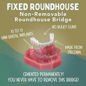 Fixed Roundhouse Bridge Supported by Mini Dental Implants