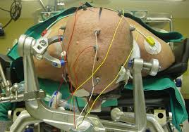 Intraoperative Monitoring Electrodes Market 2025-2032