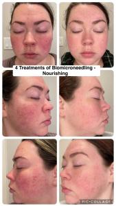 SQT Biomicroneedling Before and After