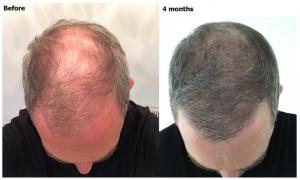 AlviArmani Patients Seeing Faster Results with PRP-Enhanced Hair Restoration Procedures