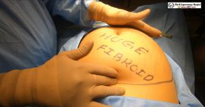 Huge Fibroid Removed by Dr R K Mishra