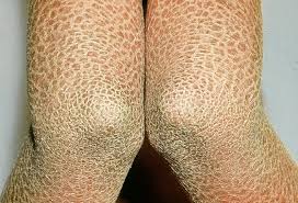 Fish Skin Disease Market Analysis
